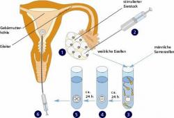 Що таке ivf